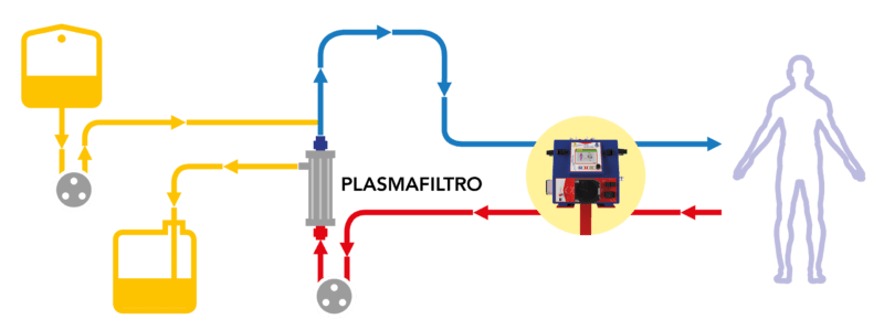 Plasmapher Plasma Exchange