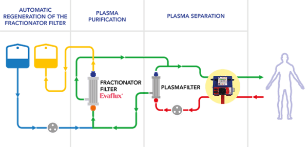 Plasmapher Double Filtration Plasmapheresis