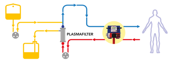 Plasmapher Plasma Exchange